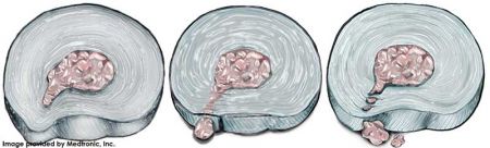 Medtronic_herniation_degrees_450_136_80