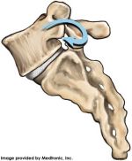 Medtronic_spondylolisthesis_bonyhook_150_182_80